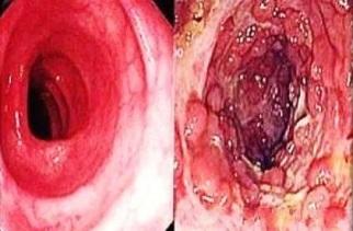 J Crohns Colitis：克罗恩病肛周瘘相关癌患者的特征及临床预后