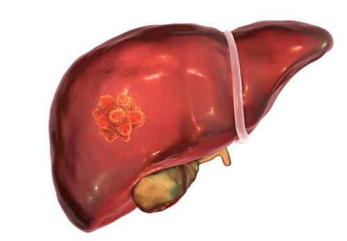 World J Gastroenterology：化学栓塞术对肝细胞癌患者短期和长期预后的影响