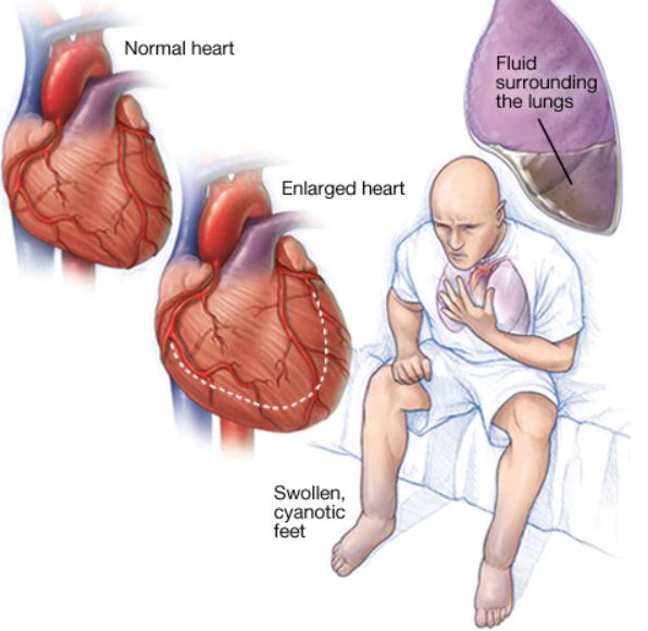 JACC：ACEI类药物对终末期心力衰竭的心肌Ang代谢的影响