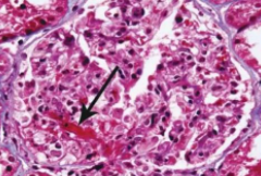Lancet：3期| Voclosporin显著提高狼疮性肾炎的完全缓解率！
