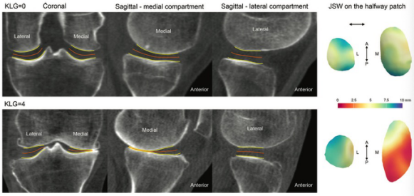 Radiology：负重CT在膝关节骨关节炎中的应用
