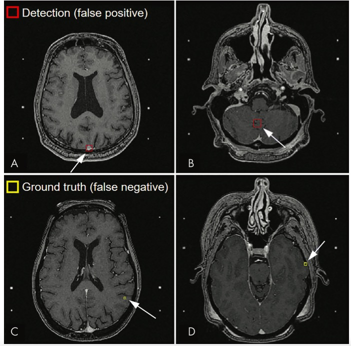 Radiology：人工智能，实现脑转移瘤的“一站式”检测