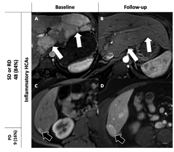 Radiology：从MRI的角度“解密”肝细胞腺瘤的长期演变