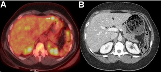 Journal of Nuclear Medicine：  <font color="red">18</font><font color="red">F</font>-<font color="red">FDG</font> <font color="red">PET</font> / <font color="red">CT</font>可发现尿道腺癌转移，指导分期和患者管理的改变