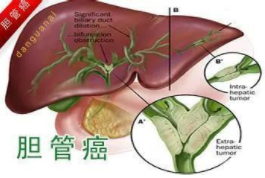 Clin Cancer Res：不同治疗方式<font color="red">和</font>基因突变<font color="red">对</font><font color="red">肝</font><font color="red">内胆管癌</font><font color="red">患者</font>预后<font color="red">的</font><font color="red">影响</font>