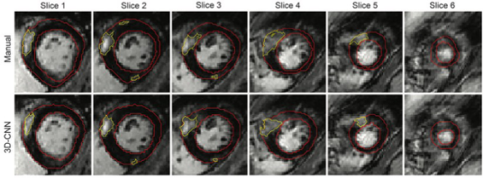 Radiology：三维深卷积神经网络使HCM心肌瘢痕自动定量成为可能