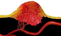 Lancet oncol：<font color="red">Cemiplimab</font>在局部晚期基底细胞癌中的抗肿瘤活性令人可期
