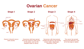 Lancet：“女性杀手”卵巢癌人群<font color="red">筛</font>查有必要吗？<font color="red">结果</font>有点意外……