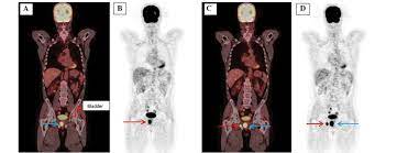 Lancet：<font color="red">PET-CT</font>辅助前列腺癌术后放化疗可有效提高生存率！