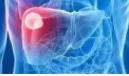 Liver Cancer：有脉管癌栓的晚期肝癌患者或可选择<font color="red">肝</font>动脉<font color="red">灌注</font>化疗+放疗！