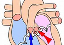JAHA：尿酸、颈动脉内膜中层厚度和心血管事件之间的关联