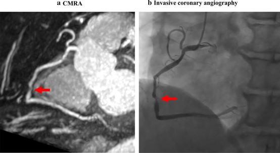 Journal of Cardiovascular Magnetic Resonance:冠脉<font color="red">狭窄</font>是否严重，查一下CMRA