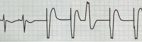 Heart Rhythm：不同新型起搏技术的心室除极差异