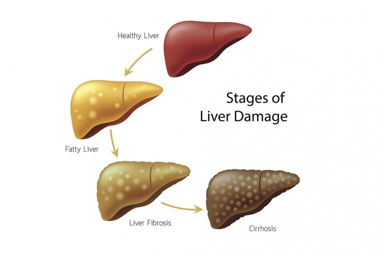 Hepatology：控制血糖可降低非酒精性脂肪肝肝纤维化风险