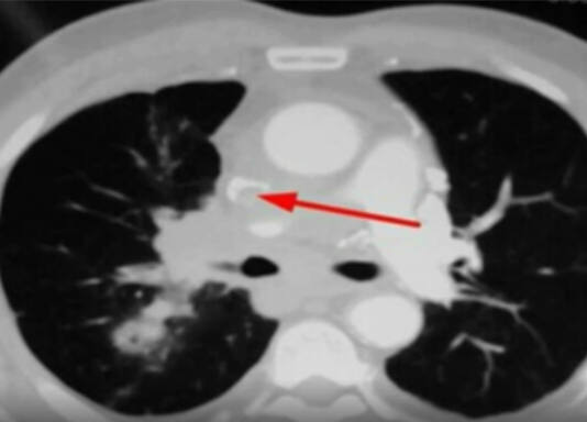 视频课程：<font color="red">小</font>细胞肺癌的影像诊断和治疗-<font color="red">张</font>嵩