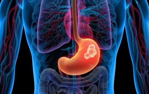 GUT: 质子泵抑制剂的使用可能会增加胃癌的发生率