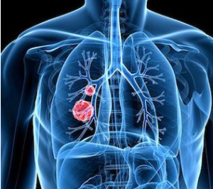 Br J Cancer：安罗替尼（Anlotinib）：小细胞肺癌患者的三线或后续治疗药物