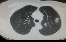 视频案例：肺腺癌的影像诊断-张<font color="red">嵩</font>