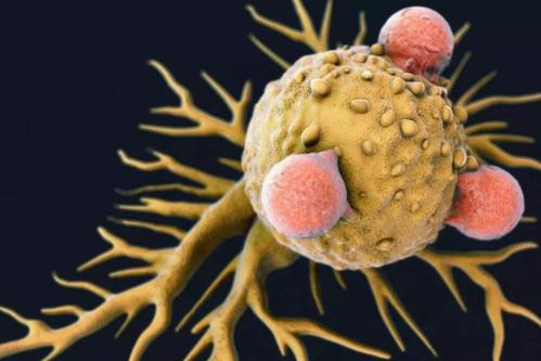 Dig Dis Sci：中性粒细胞-淋巴细胞<font color="red">比率</font>较高与肝细胞癌患者死亡率增加相关