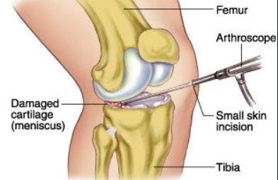 JAMA子刊：膝关节半月板切除术后，是在家“静养”还是门诊康复？
