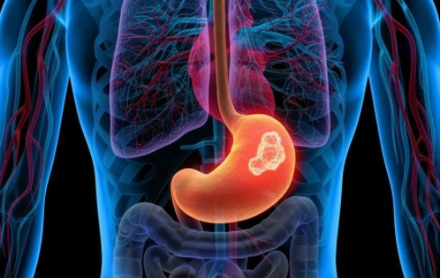 Br J Cancer：胃癌肝转移的潜在治疗靶标GNG4