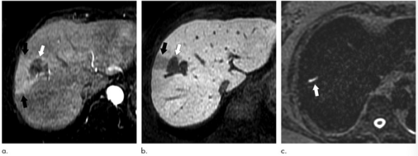Radiology：结直肠癌肝转移病灶也有HCC相似的MRI表现