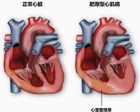 JACC：梗阻性肥厚型心肌病患者的心肌组织病理与临床特征的相关性