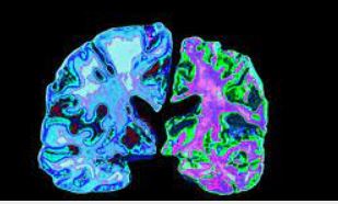 Alzherimer’s&Dementia | 临床大发现：BBB<font color="red">水</font>交换率有望预测老年痴呆的发生！