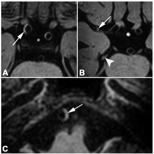 Radiology：7T MRI在颅内动脉粥样硬化中的应用