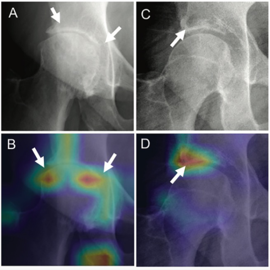 Radiology：人工智能在髋关节骨关节炎影像学特征严重程度分级中的应用
