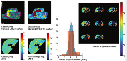 Radiology：基于磁共振弥散加权成像的虚拟弹性成像对肝纤维化的评估
