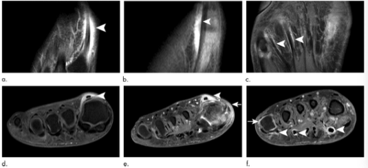 Radiology：从解剖学和影像学的角度看跖趾关节类风湿性关节炎和腱鞘炎