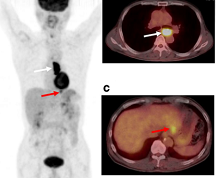 Eur J Nucl Med Mol <font color="red">Imaging</font>：采用PERCIST预测食管鳞癌患者对新辅助化疗的肿瘤反应和预后