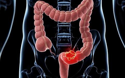 Clin Trans Gastroenterology：结肠镜检查与粪便免疫化学联合测试可降低结直肠癌风险