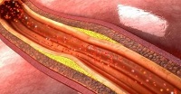 Cardiovasc Diabetol：血糖变异性与颈动脉的内膜-中膜厚度和组织特征的相关性