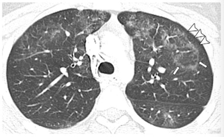 Radiology：各位家长请注意，电子烟正在“吃掉”孩子的<font color="red">肺</font>！