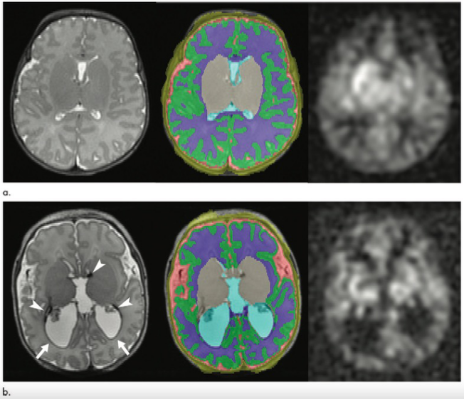 Radiology：从影像学的角度看早产儿在妊娠晚期的局部脑<font color="red">血流变化</font>