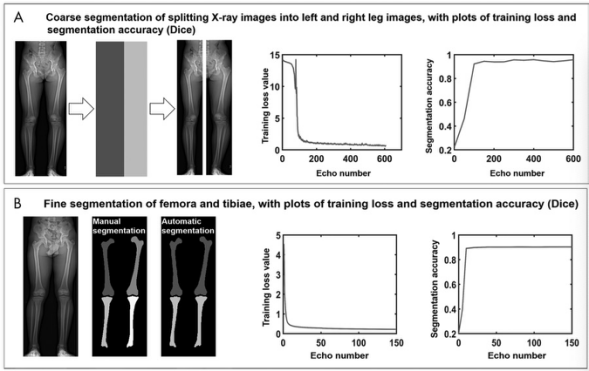 Radiology:对于腿长不符的患儿，你还在手动测量吗？