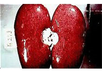 JAHA：肾脏疾病与COVID-19患者结局之间<font color="red">的</font>关联