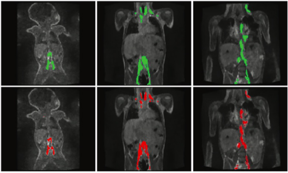 Radiology:动态增强MR淋巴管造影在定量分析<font color="red">胸部</font>淋巴流动模式中的价值
