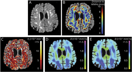 Neurology：基线血脑屏障渗漏可预测<font color="red">cSVD</font>患者白质高信号病灶周围微结构组织损伤