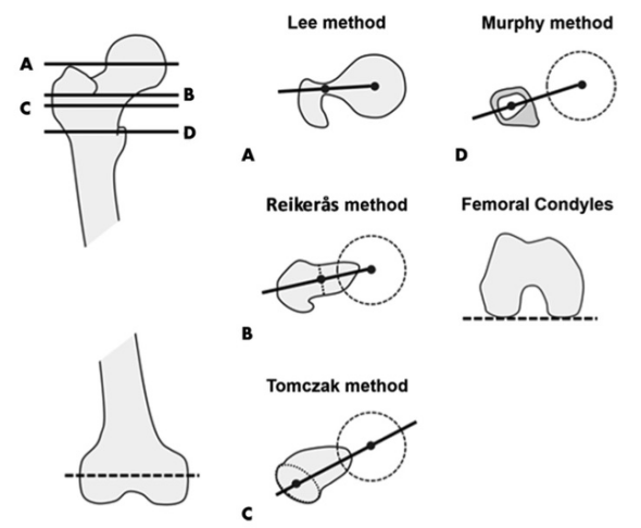 Radiology:如何准确测量股骨扭转角？