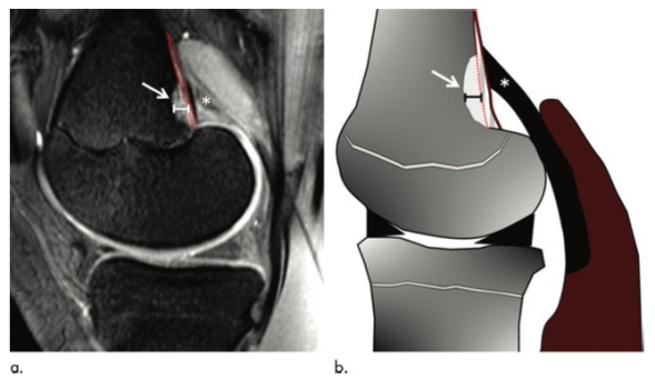 Radiology:在膝<font color="red">关节</font>MRI上看到这个征象，不要再慌张！