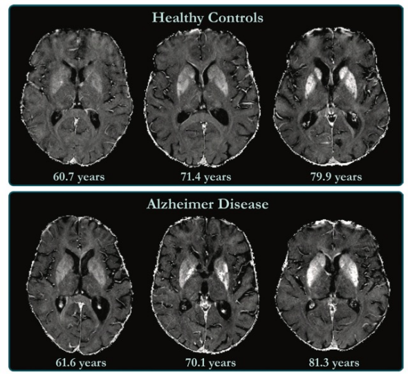 Radiology:评价AD患者脑组织铁含量水平不要再用老一套！影像学及解剖学上的新角度