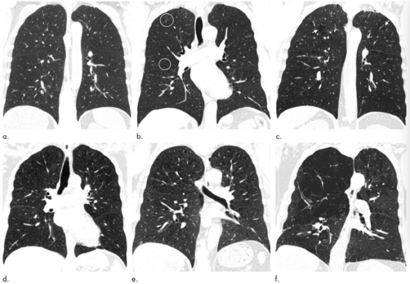 Radiology:吸烟人群看过来，CT的这一表现一定不要忽略！