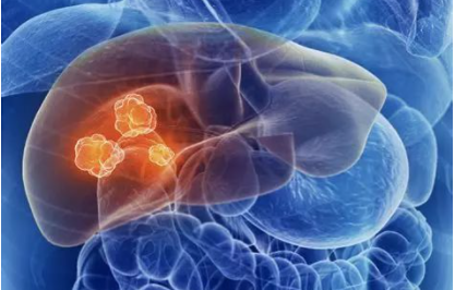 Br J Cancer：中性粒细胞淋巴细胞比值NLR在肝细胞癌中的预后和诊断意义