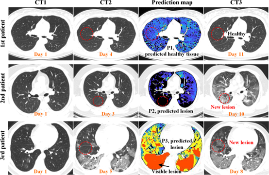 Eur J Nucl Med Mol Imaging：一种可预测COVID-19患者<font color="red">肺部</font>病变进展的新型CT通气显像技术