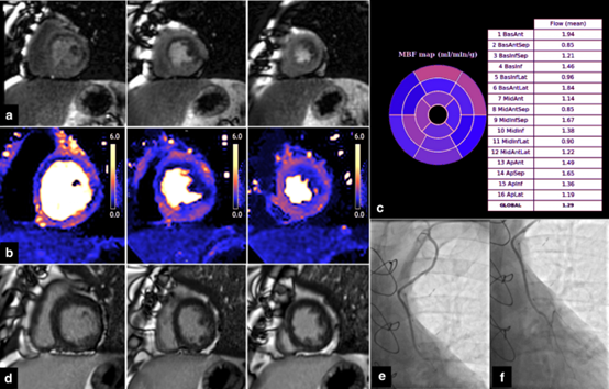 Journal of Cardiovascular Magnetic Resonance：用定量心血管磁共振<font color="red">心肌</font>灌注图表征左内乳冠状动脉搭桥术患者的<font color="red">心肌</font>缺血
