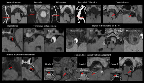 J Cardiovasc Magn Reson：利用高分辨率心血管磁共振识别颅内动脉夹层的高危临床和影像学特征