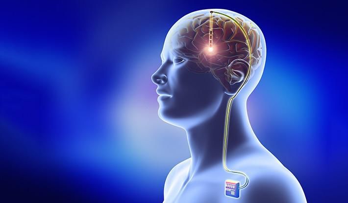 Neuromodulation:丘脑底核脑深部刺激幅度增加对帕金森病眼动抑制性控制的影响